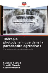 Thérapie photodynamique dans la parodontite agressive :